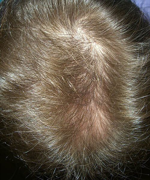man with golder hair after lasercap