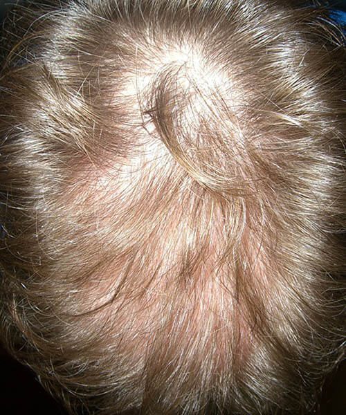golden hair before lasercap