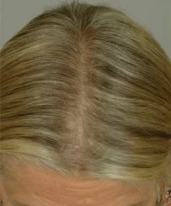 blonde hair after lasercap treatment