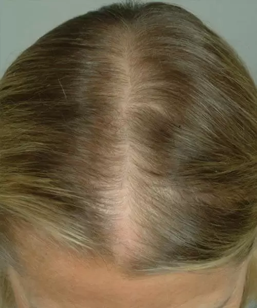 blonde hair before lasercap treatment