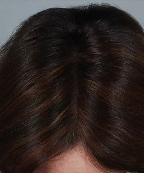 woman with brown hair after lasercap