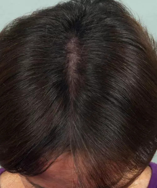 woman with brown hair before lasercap