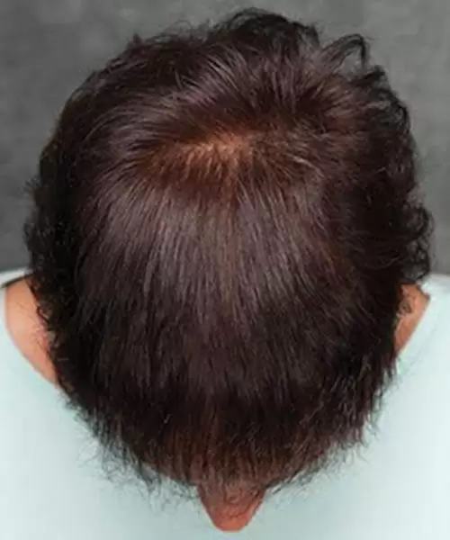 man with dark hair after lasercap treatment