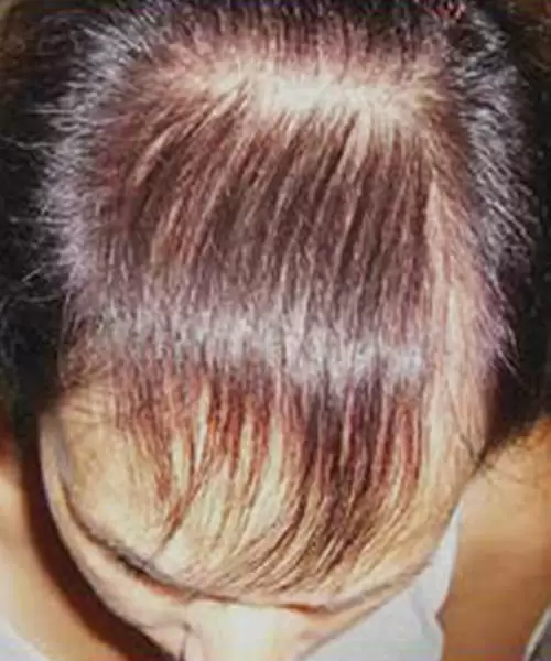 man with dark hair before lasercap treatment