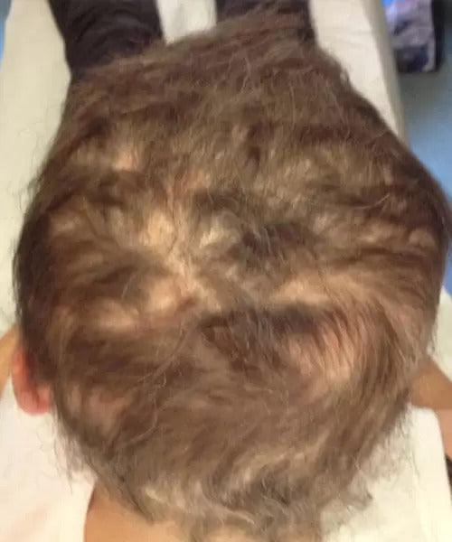 curly hair before lasercap