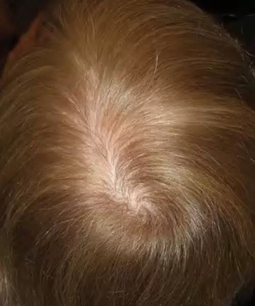 woman with blonde hair after lasercap