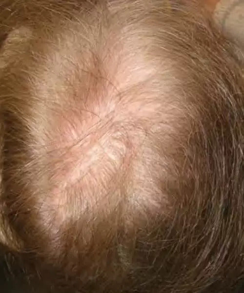 woman with blonde hair before lasercap